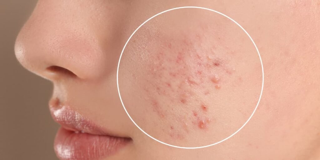 Acne causes & skin care with daily routine